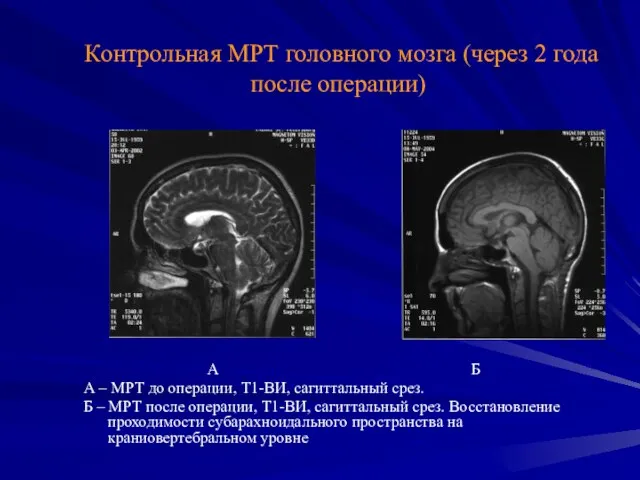 Контрольная МРТ головного мозга (через 2 года после операции) А Б