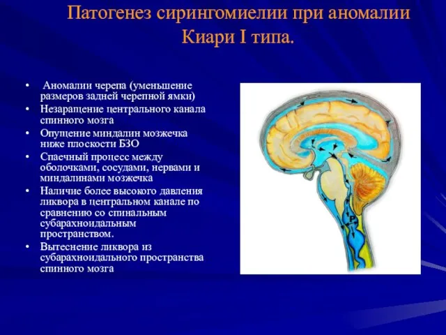 Патогенез сирингомиелии при аномалии Киари I типа. Аномалии черепа (уменьшение размеров