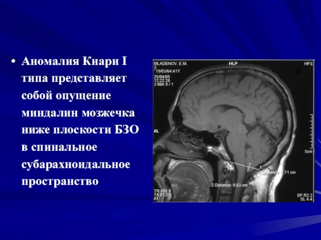 Аномалия Киари I типа представляет собой опущение миндалин мозжечка ниже плоскости БЗО в спинальное субарахноидальное пространство