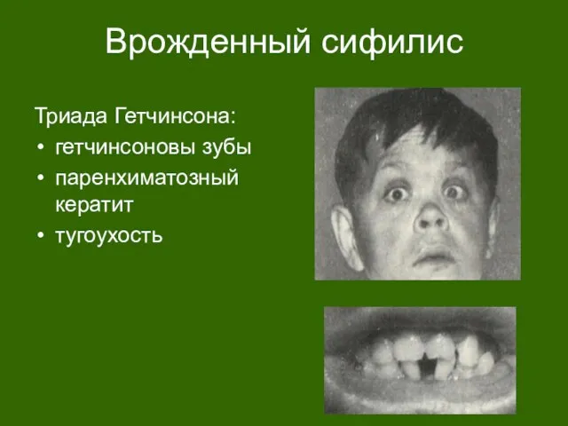 Врожденный сифилис Триада Гетчинсона: гетчинсоновы зубы паренхиматозный кератит тугоухость