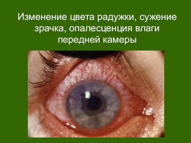 Изменение цвета радужки, сужение зрачка, опалесценция влаги передней камеры