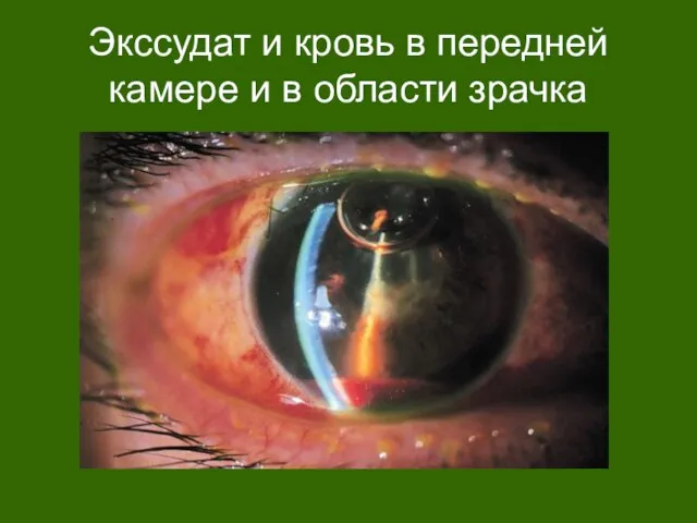 Экссудат и кровь в передней камере и в области зрачка