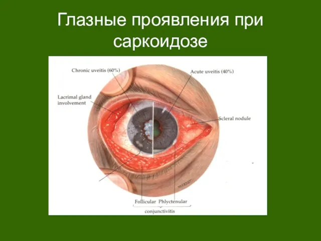 Глазные проявления при саркоидозе