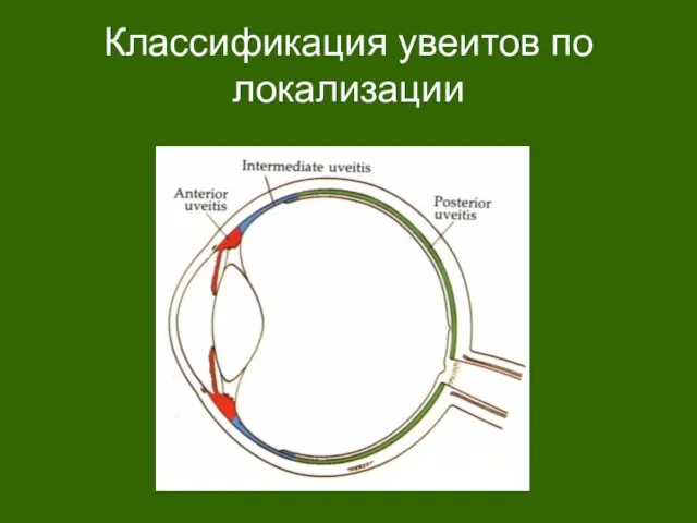 Классификация увеитов по локализации