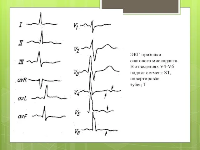 ЭКГ-признаки очагового миокардита. В отведениях V4-V6 поднят сегмент ST, инвертирован зубец T