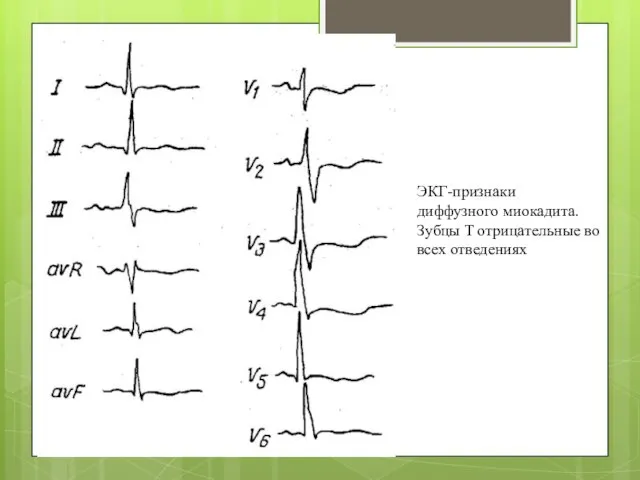 ЭКГ-признаки диффузного миокадита.Зубцы Т отрицательные во всех отведениях