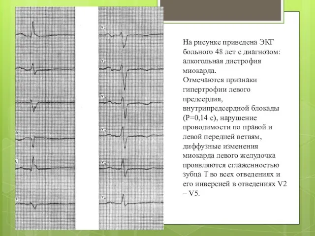 На рисунке приведена ЭКГ больного 48 лет с диагнозом: алкогольная дистрофия