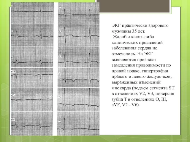 ЭКГ практически здорового мужчины 35 лет. Жалоб и каких-либо клинических проявлений