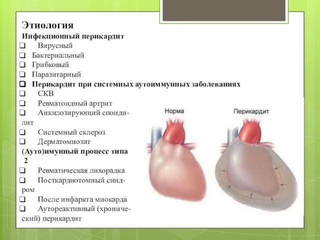 Этиология Инфекционный перикардит Вирусный Бактериальный Грибковый Паразитарный Перикардит при системных аутоиммунных