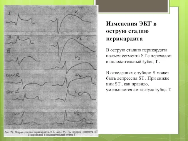 В острую стадию перикардита подъем сегмента ST с переходом в положительный