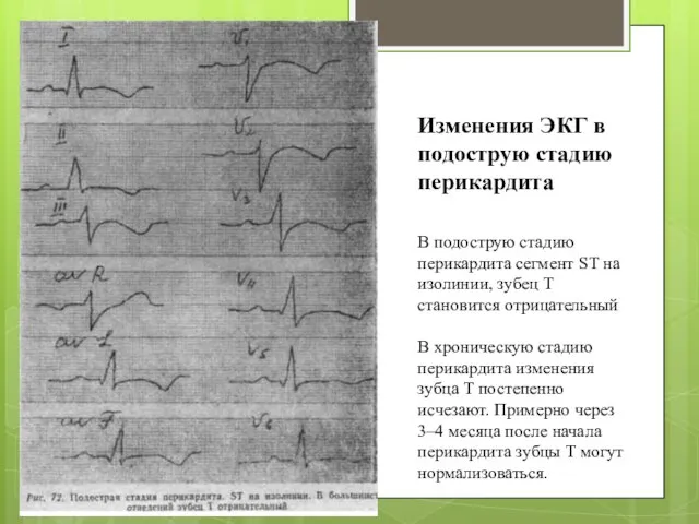 В подострую стадию перикардита сегмент ST на изолинии, зу­бец Т становится