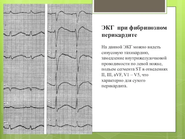 ЭКГ при фибринозном перикардите На данной ЭКГ можно видеть синусовую тахикардию,