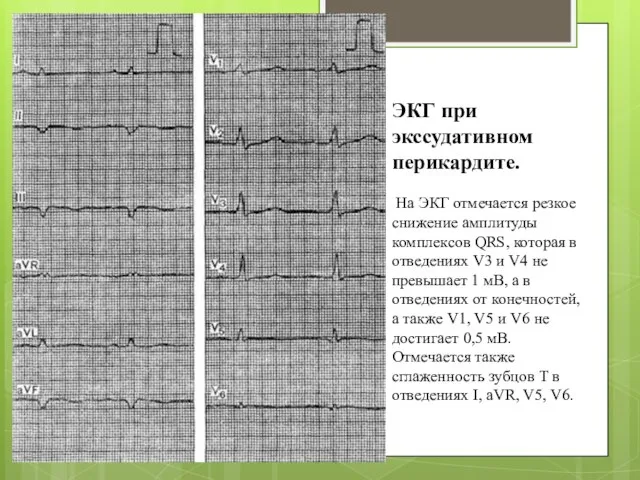 ЭКГ при экссудативном перикардите. На ЭКГ отмечается резкое снижение амплитуды комплексов