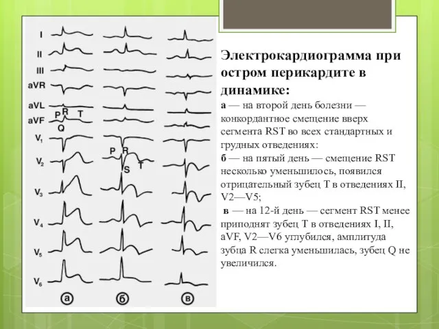 Электрокардиограмма при остром перикардите в динамике: а — на второй день