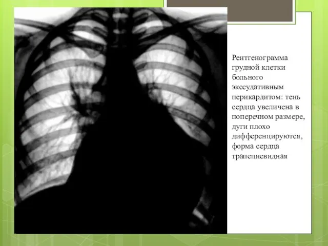 Рентгенограмма грудной клетки больного экссудативным перикардитом: тень сердца увеличена в поперечном