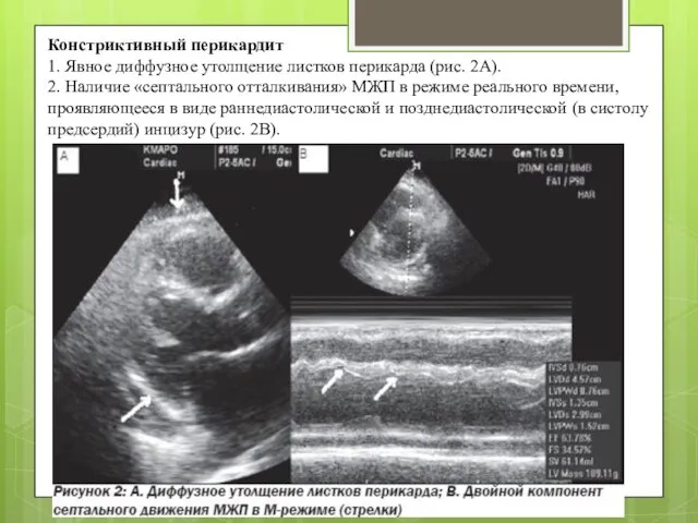 Констриктивный перикардит 1. Явное диффузное утолщение листков перикарда (рис. 2А). 2.