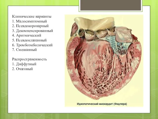 Клинические варианты 1. Малосимптомный 2. Псевдокоронарный 3. Декомпенсированный 4. Аритмический 5.