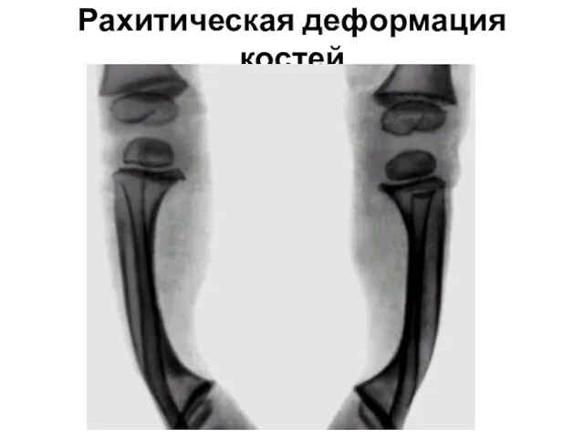 Рахитическая деформация костей