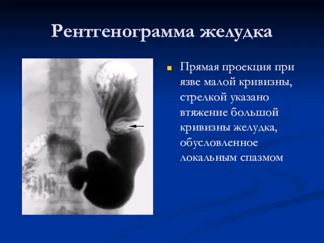 Рентгенограмма желудка Прямая проекция при язве малой кривизны, стрелкой указано втяжение