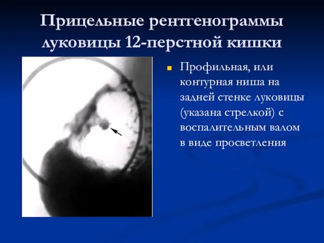 Прицельные рентгенограммы луковицы 12-перстной кишки Профильная, или контурная ниша на задней