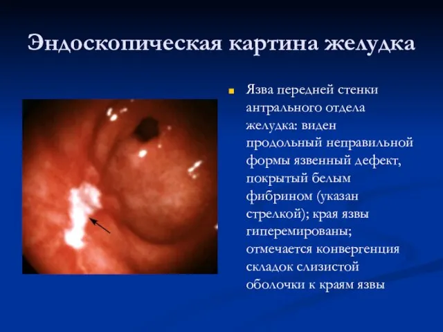 Эндоскопическая картина желудка Язва передней стенки антрального отдела желудка: виден продольный