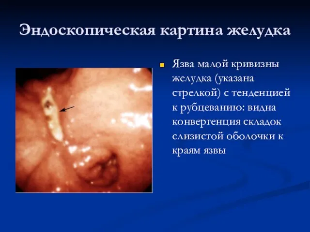 Эндоскопическая картина желудка Язва малой кривизны желудка (указана стрелкой) с тенденцией