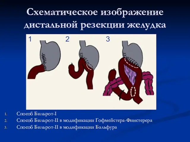 Схематическое изображение дистальной резекции желудка Способ Бильрот-I Способ Бильрот-II в модификации