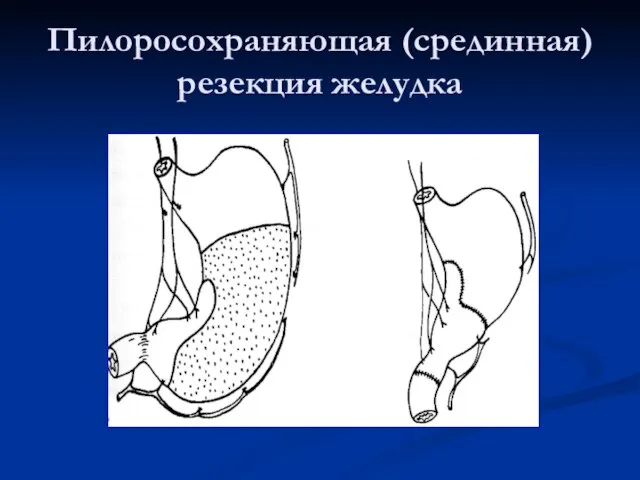 Пилоросохраняющая (срединная) резекция желудка