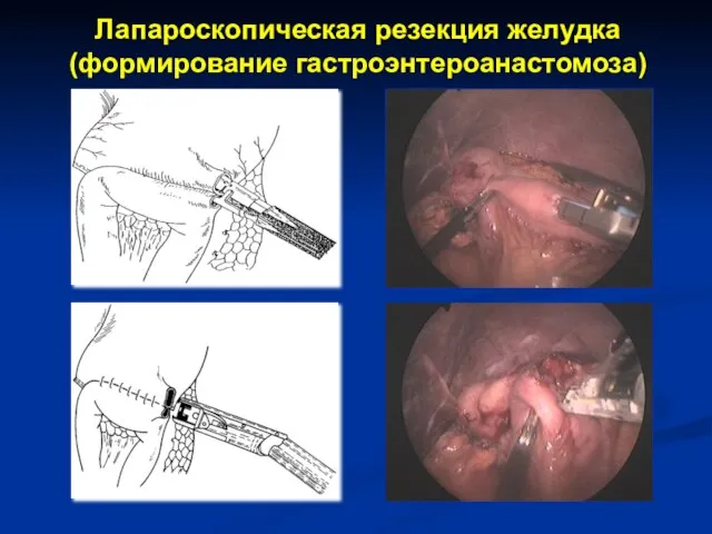 Лапароскопическая резекция желудка (формирование гастроэнтероанастомоза)