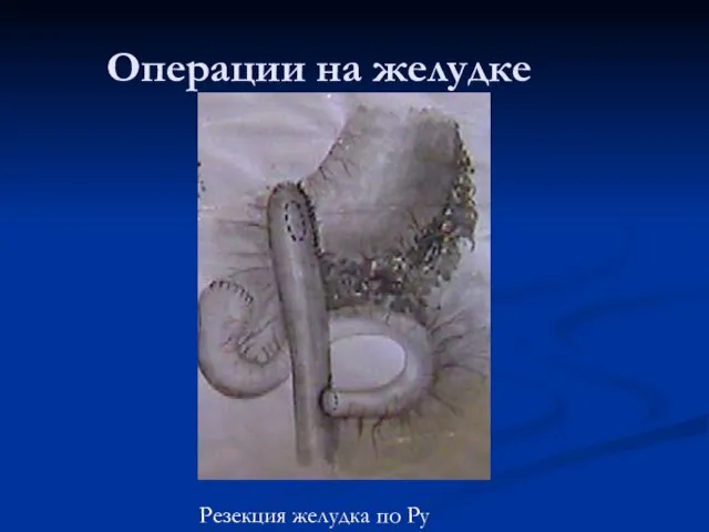 Операции на желудке Резекция желудка по Ру