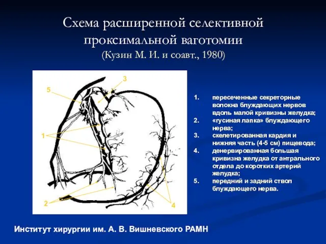 Схема расширенной селективной проксимальной ваготомии (Кузин М. И. и соавт., 1980)