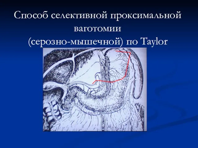 Способ селективной проксимальной ваготомии (серозно-мышечной) по Taylor