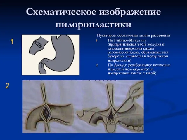 Схематическое изображение пилоропластики Пунктиром обозначены линии рассечения По Гейнеке-Микуличу (привратниковая часть