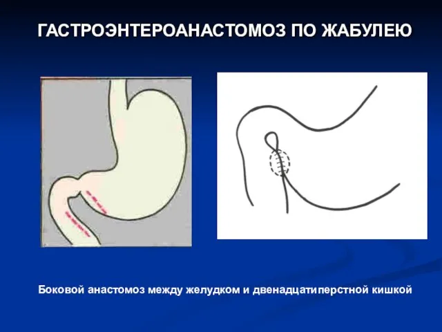 ГАСТРОЭНТЕРОАНАСТОМОЗ ПО ЖАБУЛЕЮ Боковой анастомоз между желудком и двенадцатиперстной кишкой