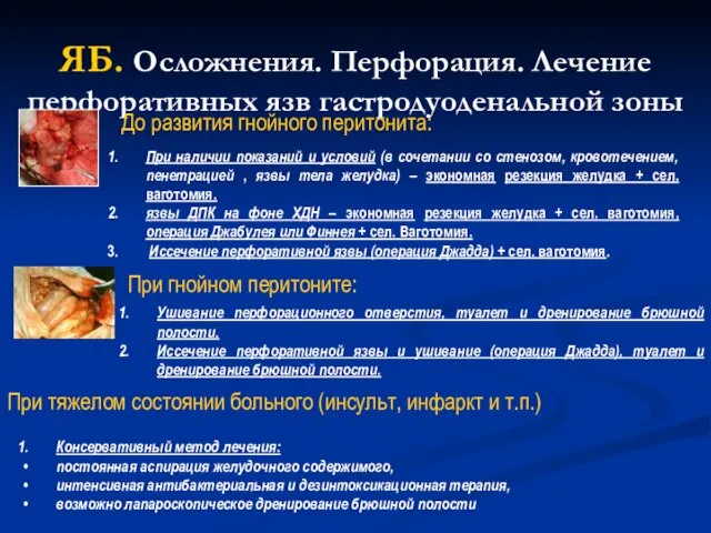 ЯБ. Осложнения. Перфорация. Лечение перфоративных язв гастродуоденальной зоны При наличии показаний