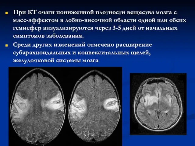 При КТ очаги пониженной плотности вещества мозга с масс-эффектом в лобно-височной