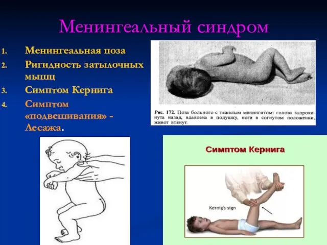 Менингеальный синдром Менингеальная поза Ригидность затылочных мышц Симптом Кернига Симптом «подвешивания» - Лесажа.