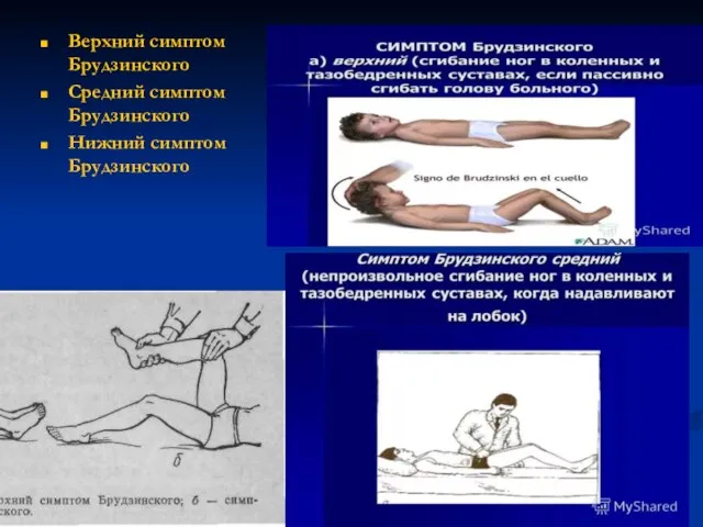 Верхний симптом Брудзинского Средний симптом Брудзинского Нижний симптом Брудзинского