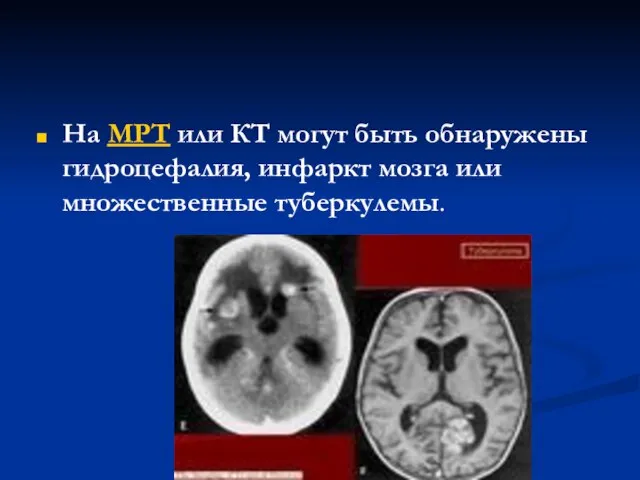 На МРТ или КТ могут быть обнаружены гидроцефалия, инфаркт мозга или множественные туберкулемы.