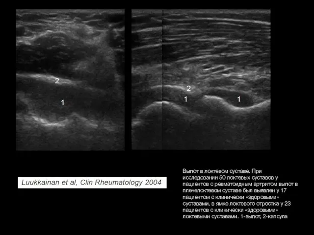 Выпот в локтевом суставе. При исследовании 50 локтевых суставов у пациентов