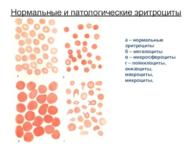 Нормальные и патологические эритроциты а – нормальные эритроциты б – мегалоциты