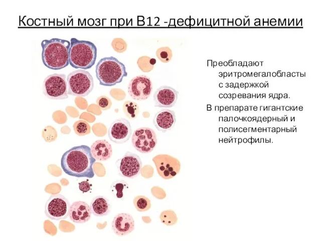 Костный мозг при В12 -дефицитной анемии Преобладают эритромегалобласты с задержкой созревания