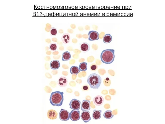 Костномозговое кроветворение при В12-дефицитной анемии в ремиссии