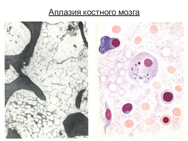 Аплазия костного мозга