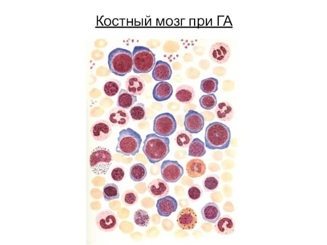 Костный мозг при ГА