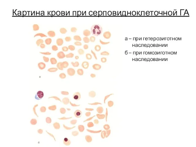 Картина крови при серповидноклеточной ГА а – при гетерозиготном наследовании б – при гомозиготном наследовании