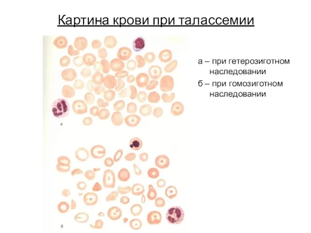 Картина крови при талассемии а – при гетерозиготном наследовании б – при гомозиготном наследовании