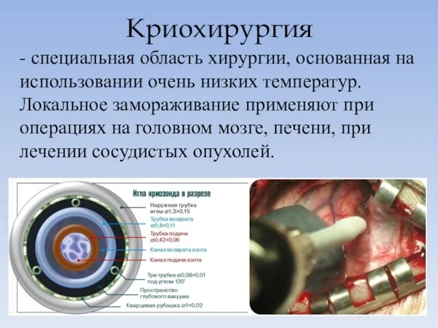 Криохирургия - специальная область хирургии, основанная на использовании очень низких температур.