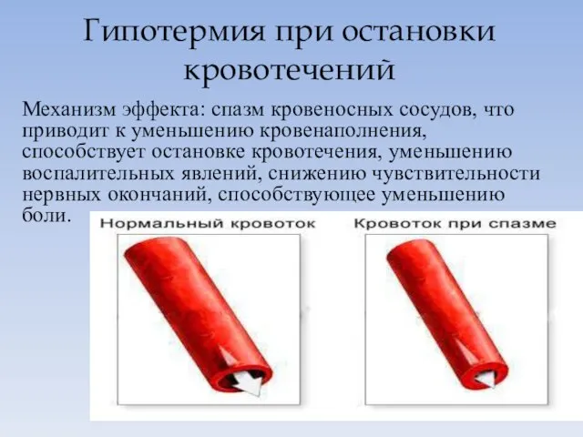 Гипотермия при остановки кровотечений Механизм эффекта: спазм кровеносных сосудов, что приводит