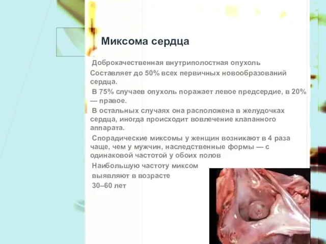 Миксома сердца Доброкачественная внутриполостная опухоль Составляет до 50% всех первичных новообразований